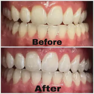/img/31908-teeth-whitening-st-george-utah-healthy-gums.webp
