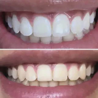 /img/31917-after-teeth-whitening.webp