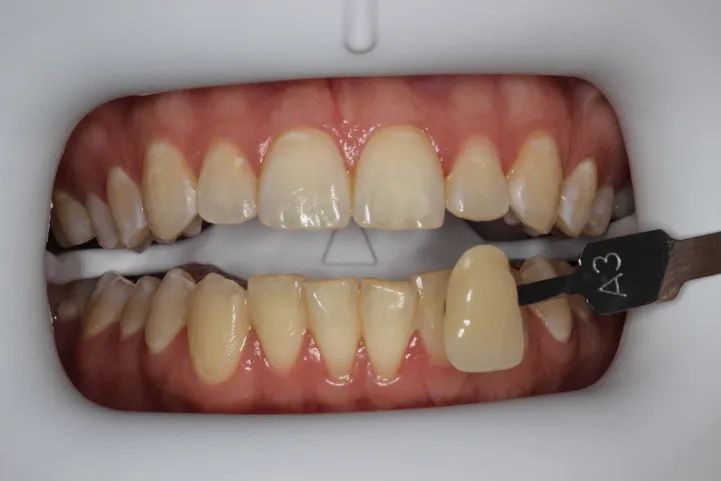 31919 teeth whitening stockton image5