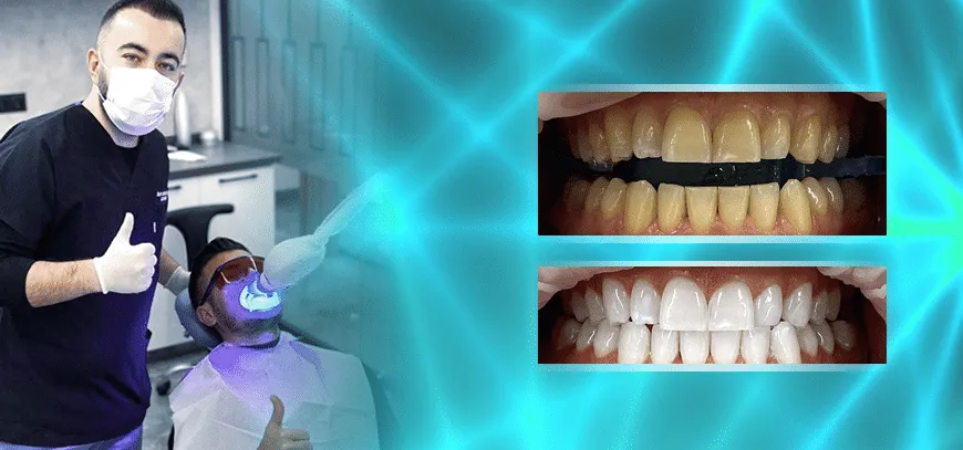 31922 teeth whitening before after