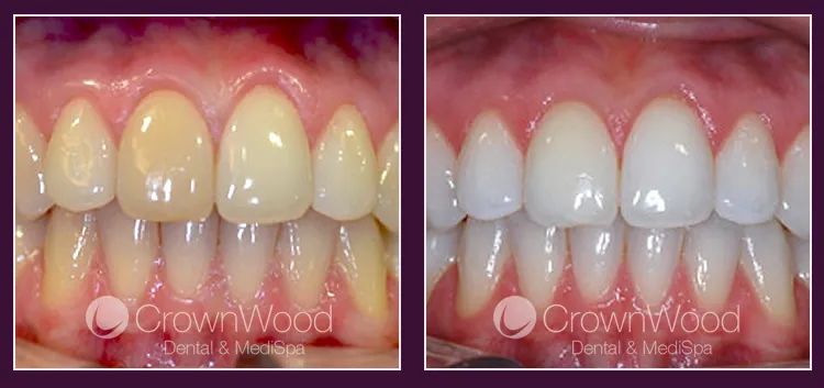 31925 teeth whitening at home