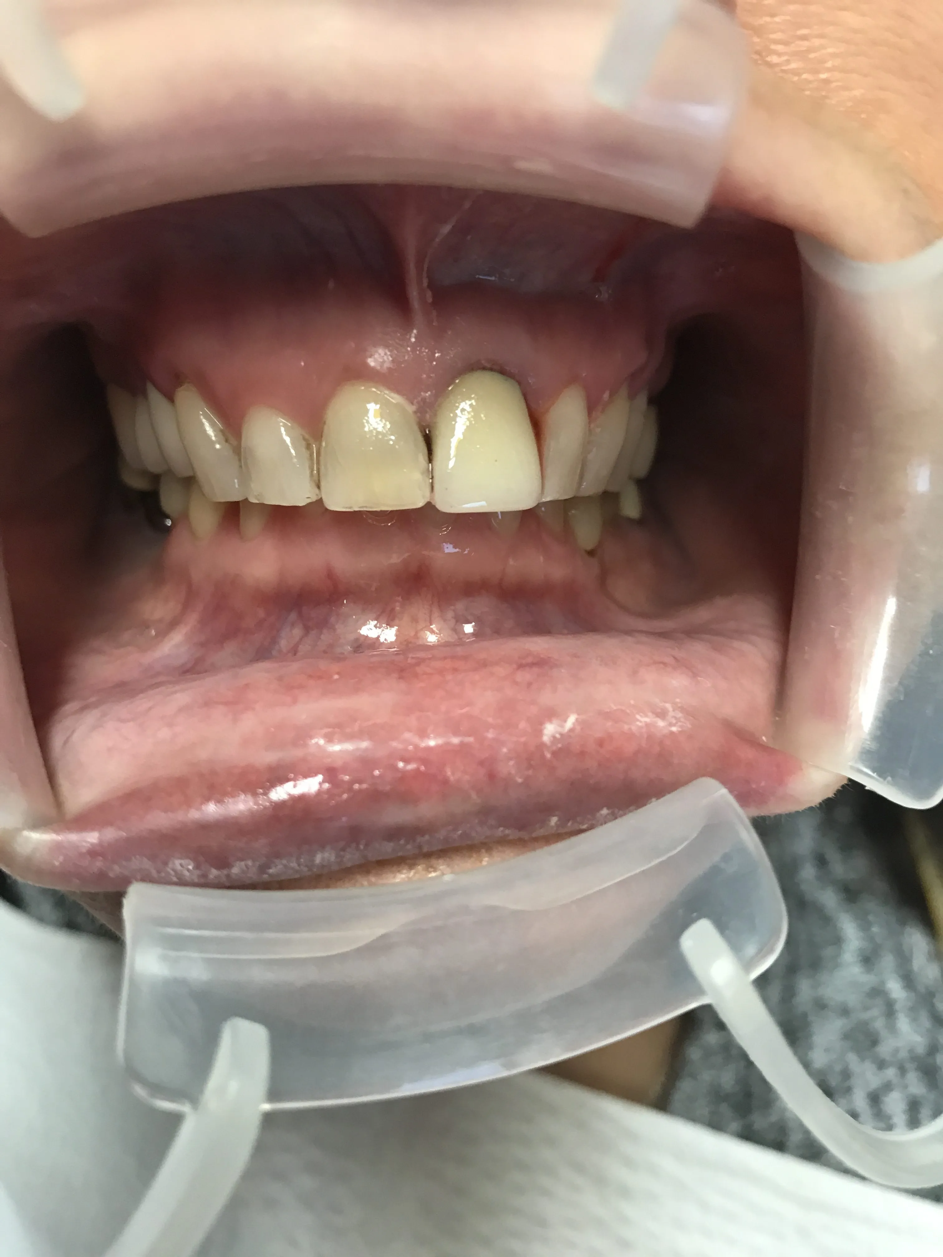 31925 teeth whitening oral hygiene