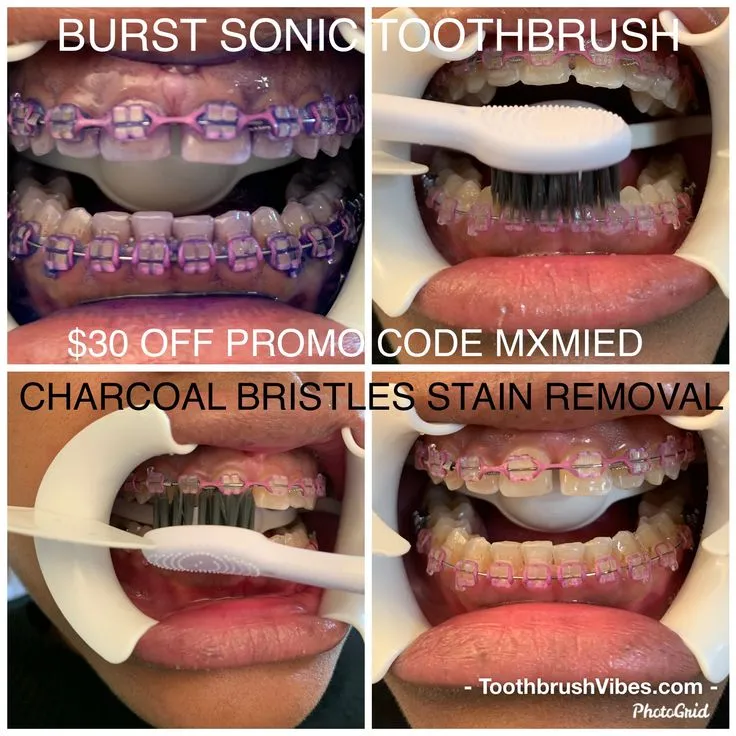 31930 oral hygiene with braces