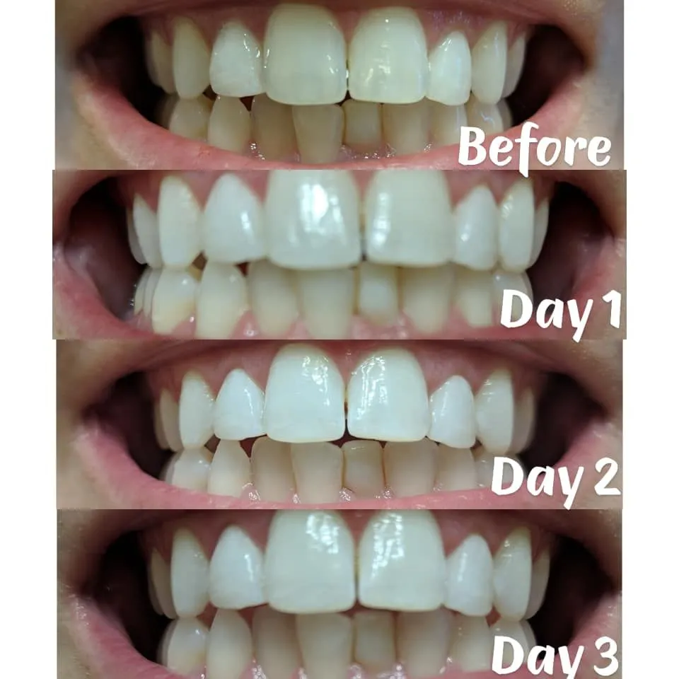 31931 teeth whitening process