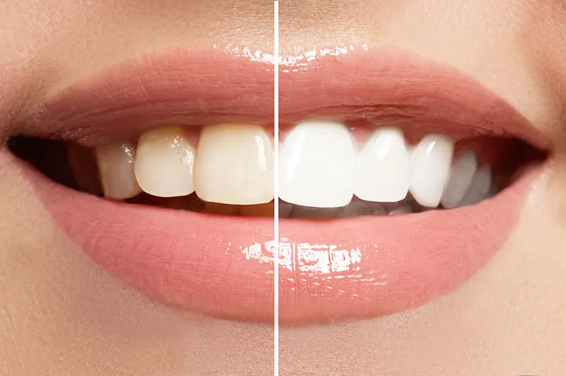 31940 professional teeth whitening