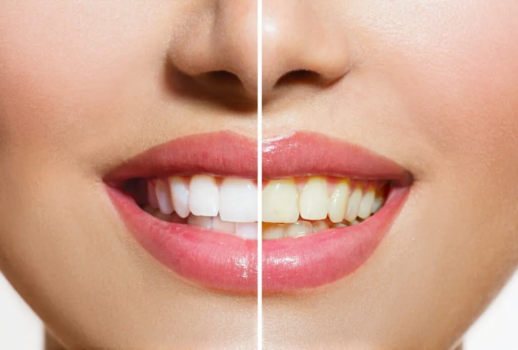 31942 choosing teeth whitening provider