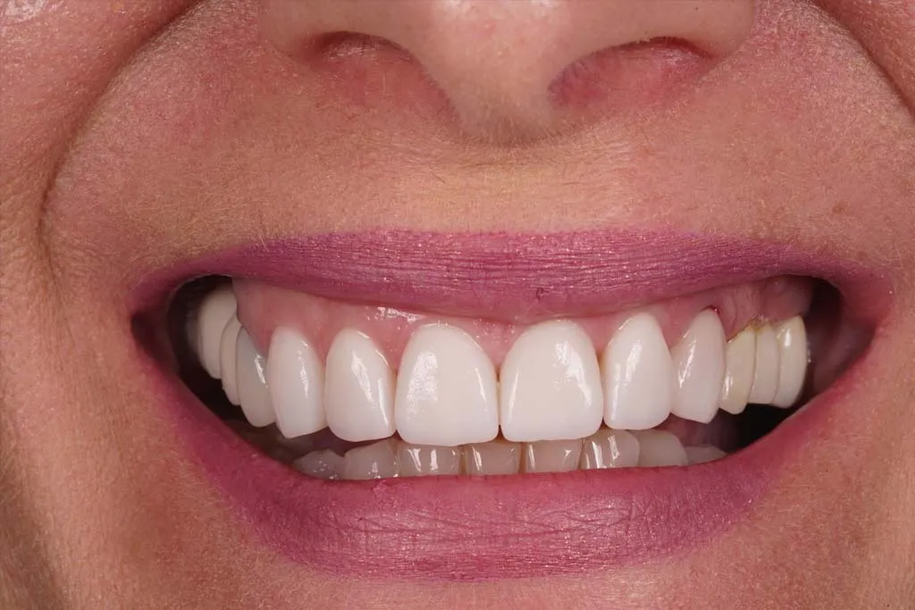31948 teeth whitening process