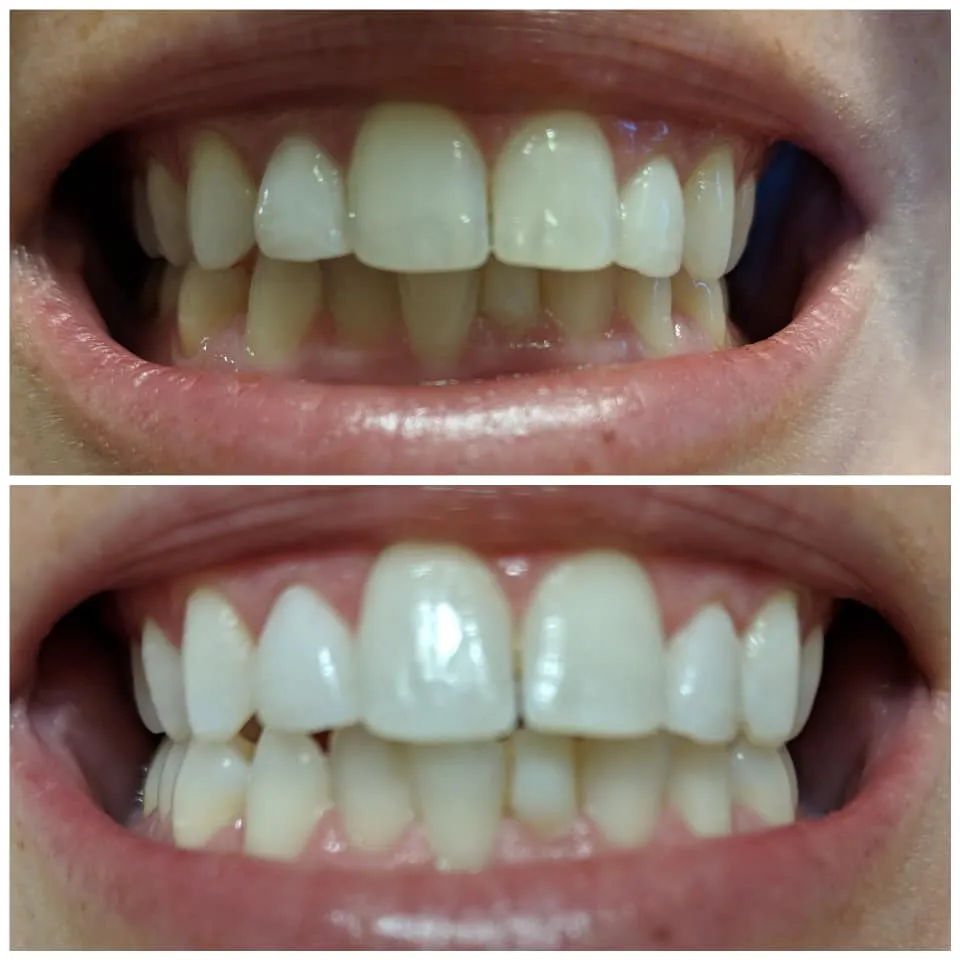 31955 teeth whitening strips ingredients
