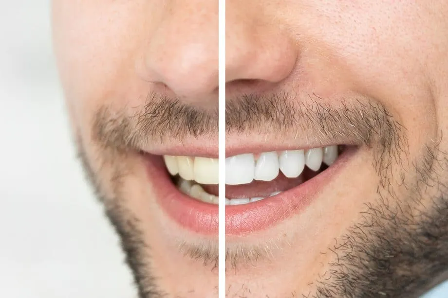 /img/31955-teeth-whitening-strips-side-effects.webp