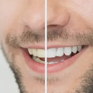 /img/31955-teeth-whitening-strips-side-effects.webp