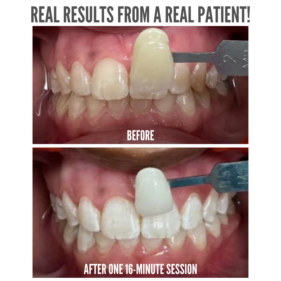 31958 glowlyco teeth whitening oral hygiene