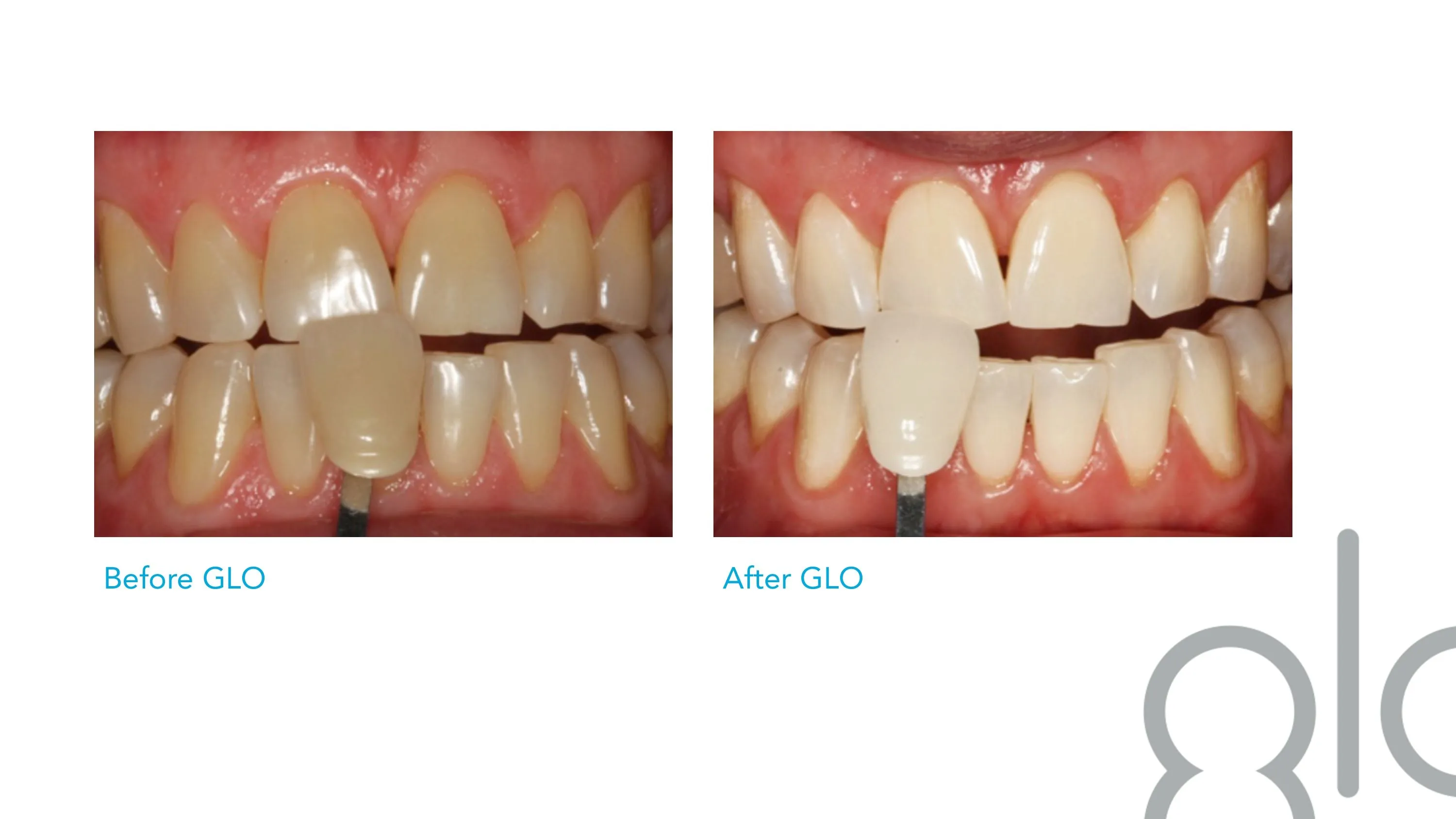 31958 teeth whitening confidence