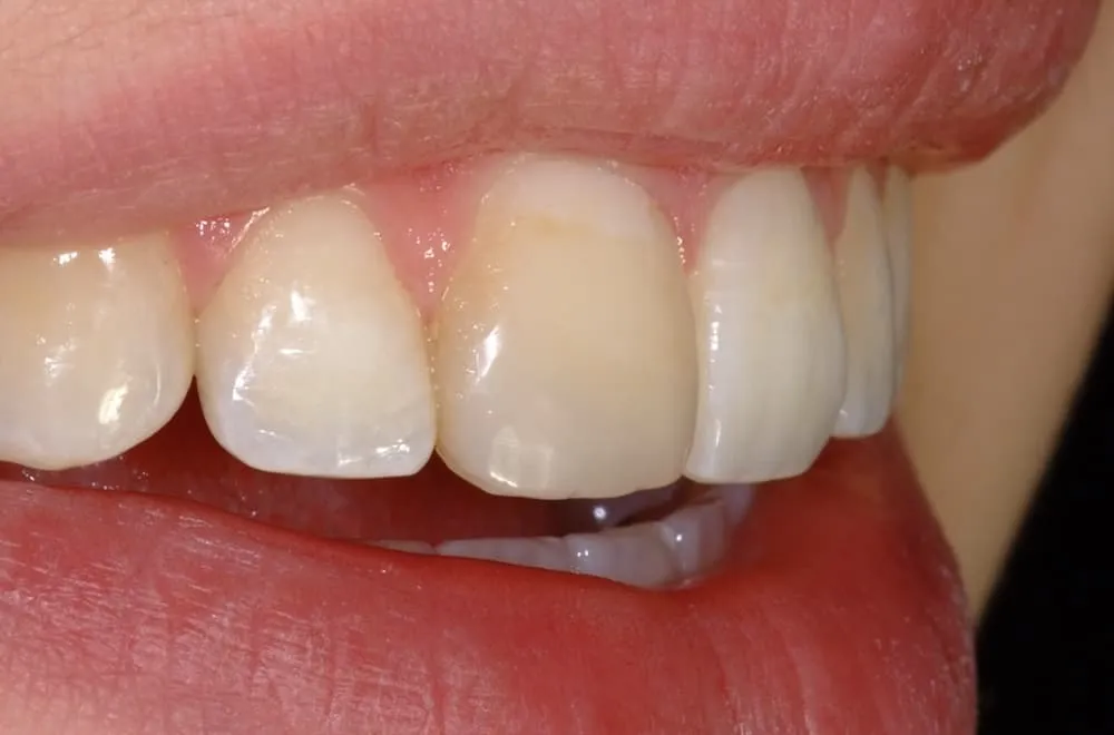 31970 at home whitening kit