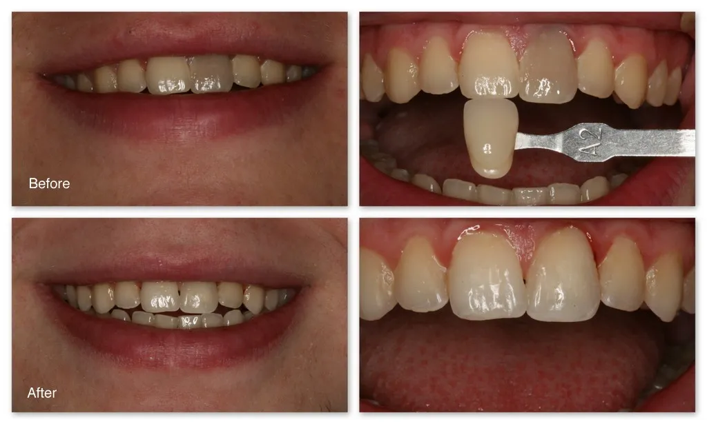 31970 in office whitening