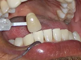 31970 nc tooth whitening results