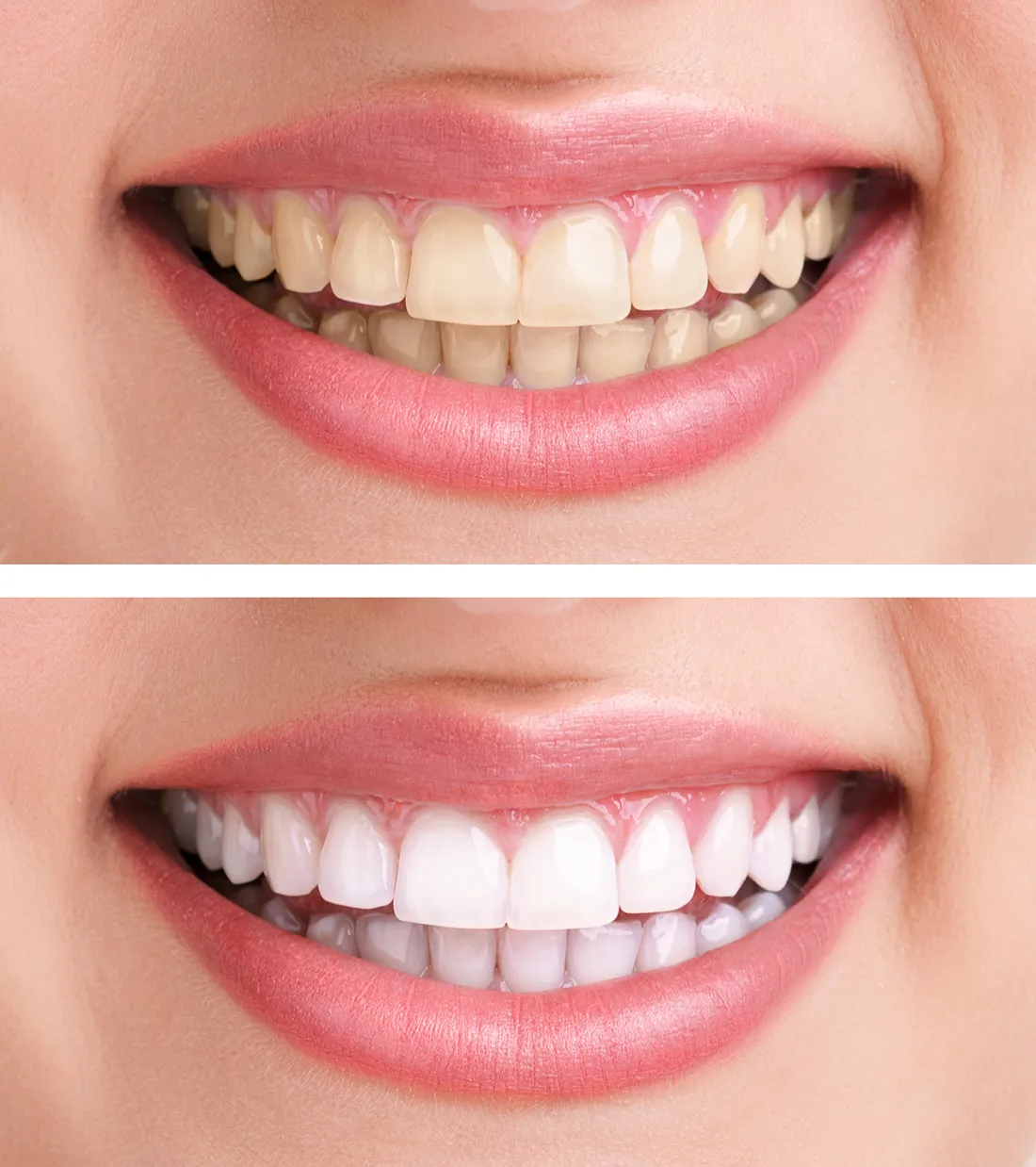 31970 nc tooth whitening smile