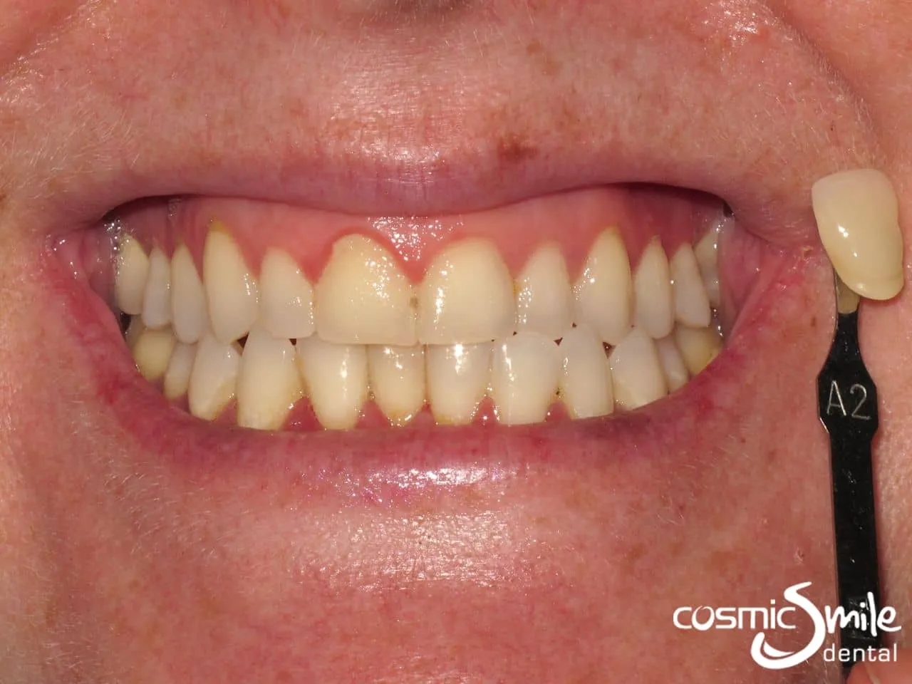 31982 zoom teeth whitening