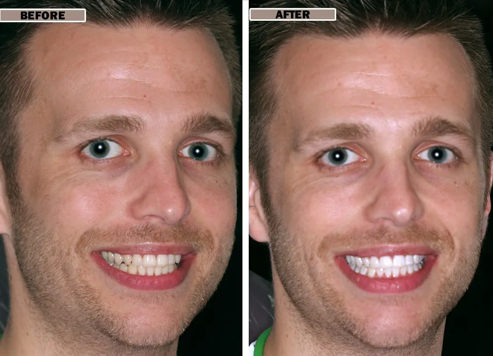 /img/31986-teeth-whitening-comparison.webp