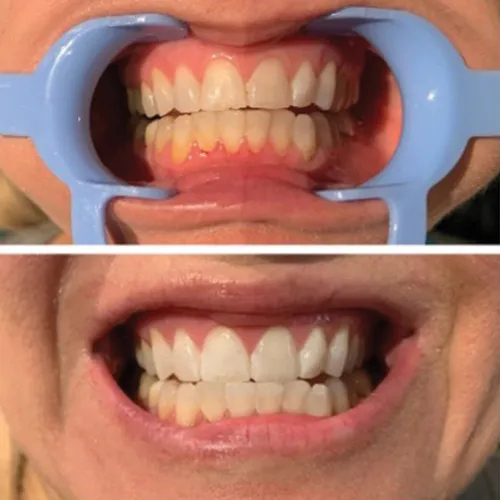 31988 convenient teeth whitening