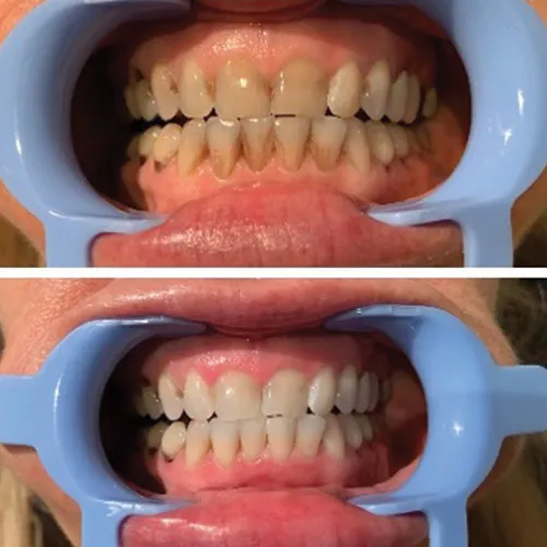 31988 non invasive procedure