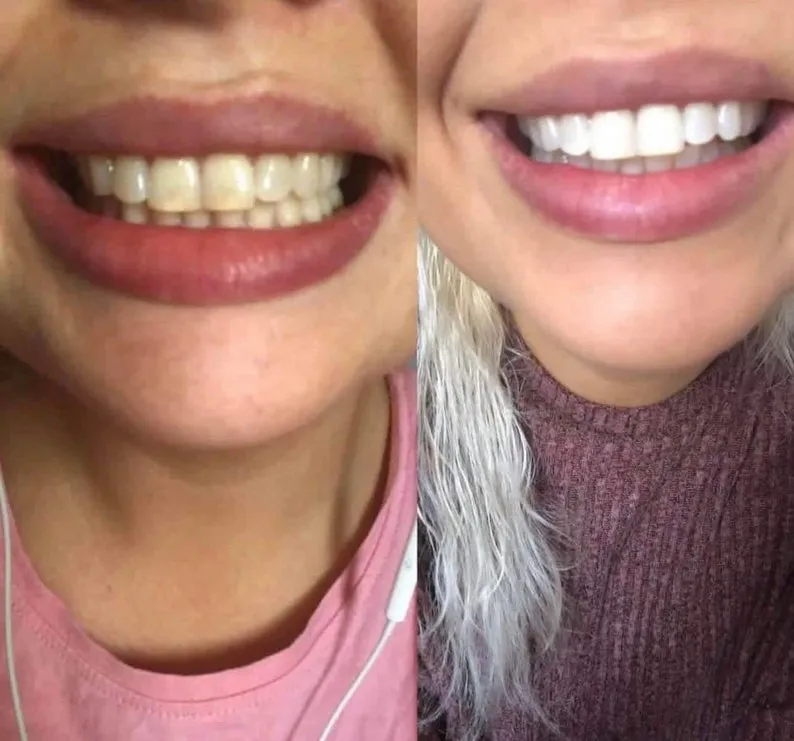 31992 alternative teeth whitening