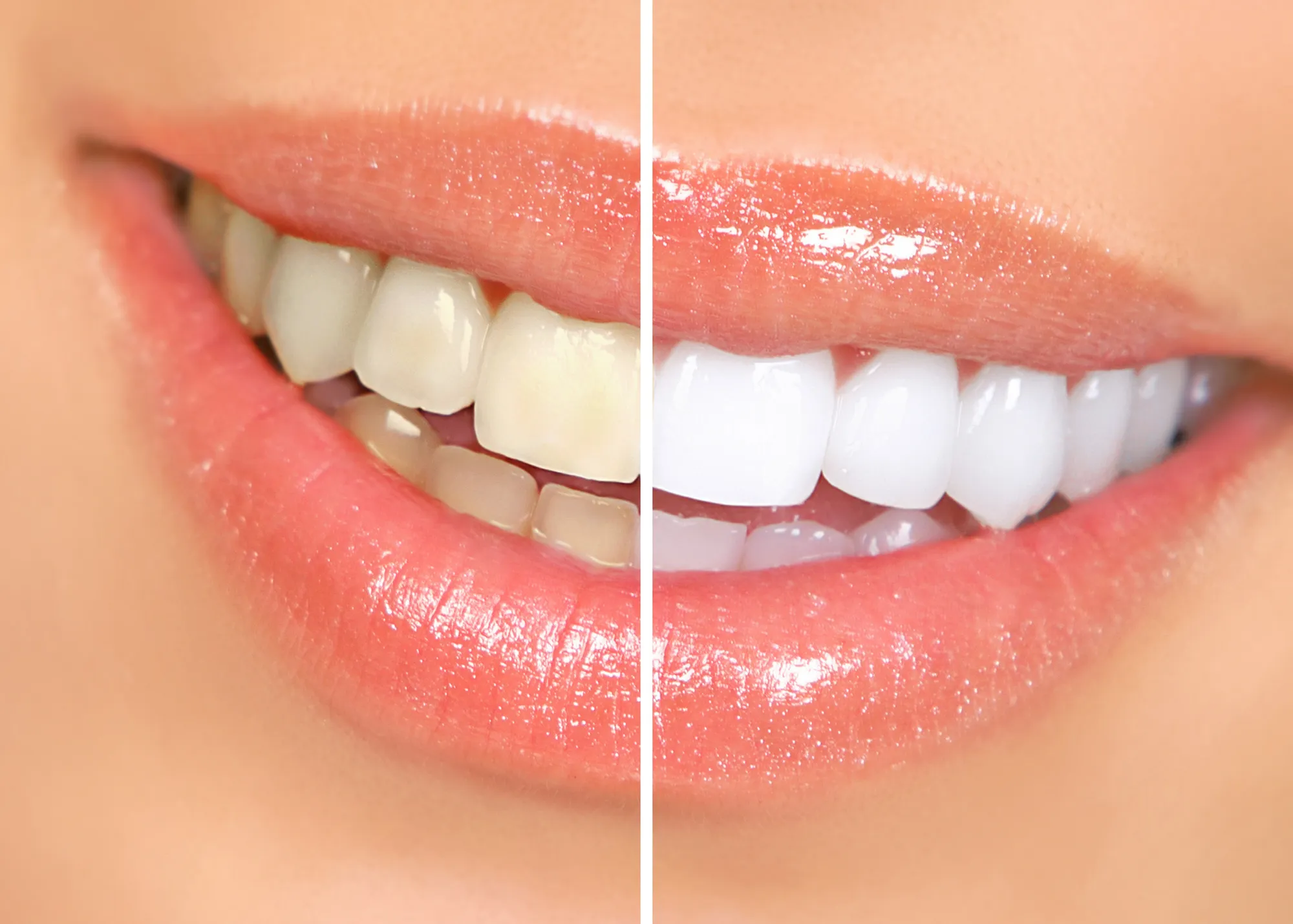 31993 teeth whitening options
