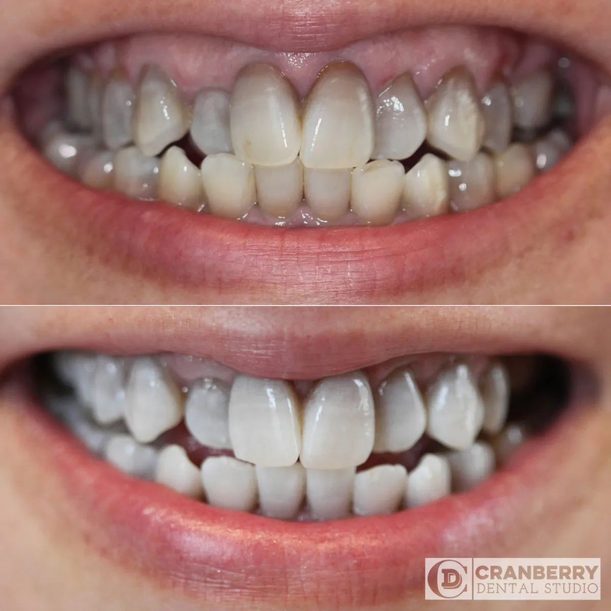 /img/31993-teeth-whitening-results.webp