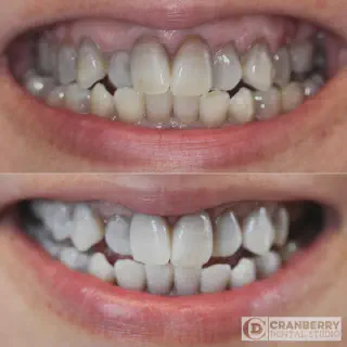 /img/31993-teeth-whitening-results.webp