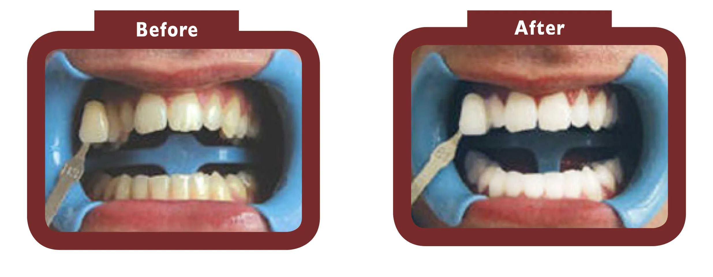 31994 laser teeth whitening foods