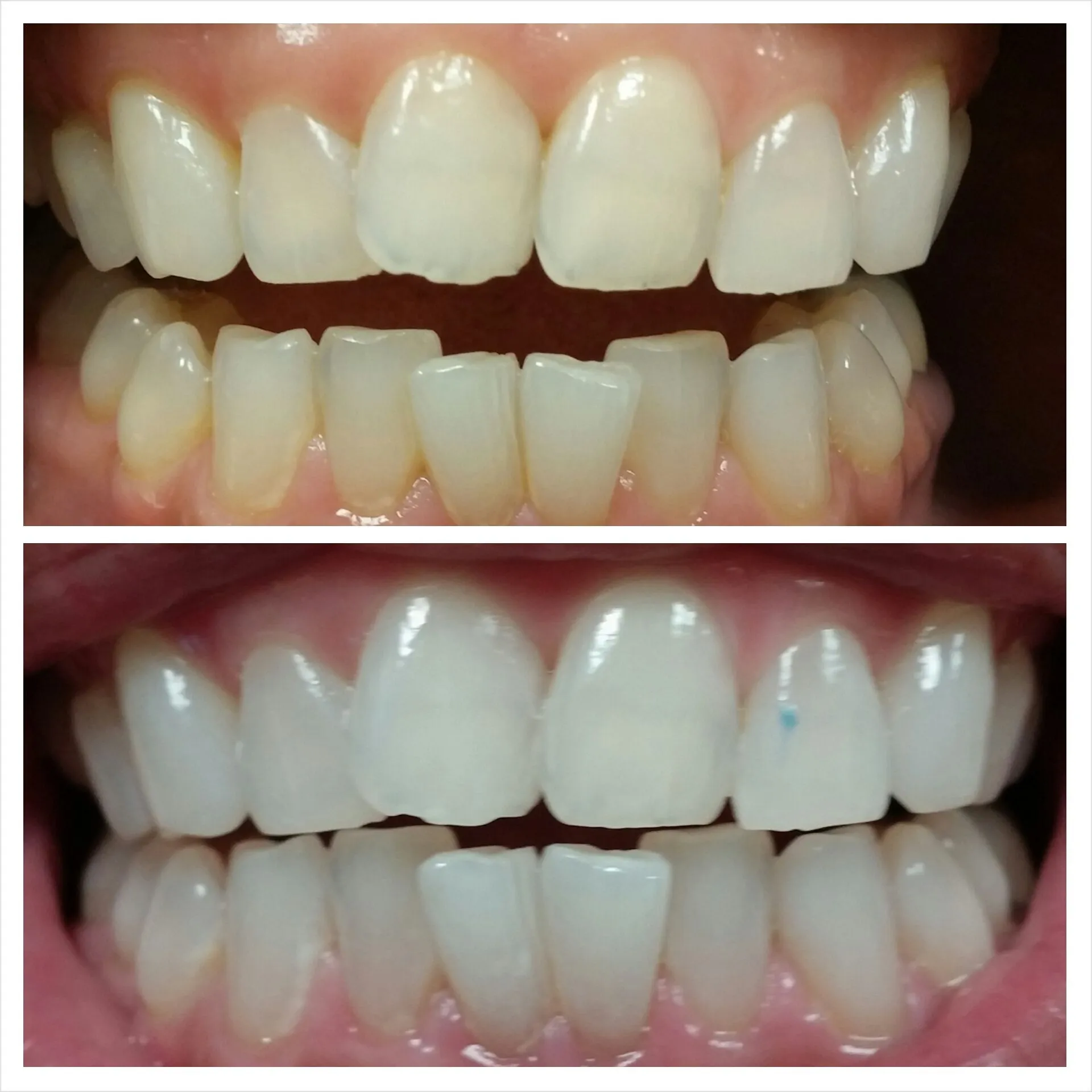 31994 laser teeth whitening maintenance