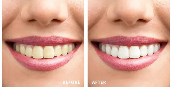31994 teeth whitening checkup