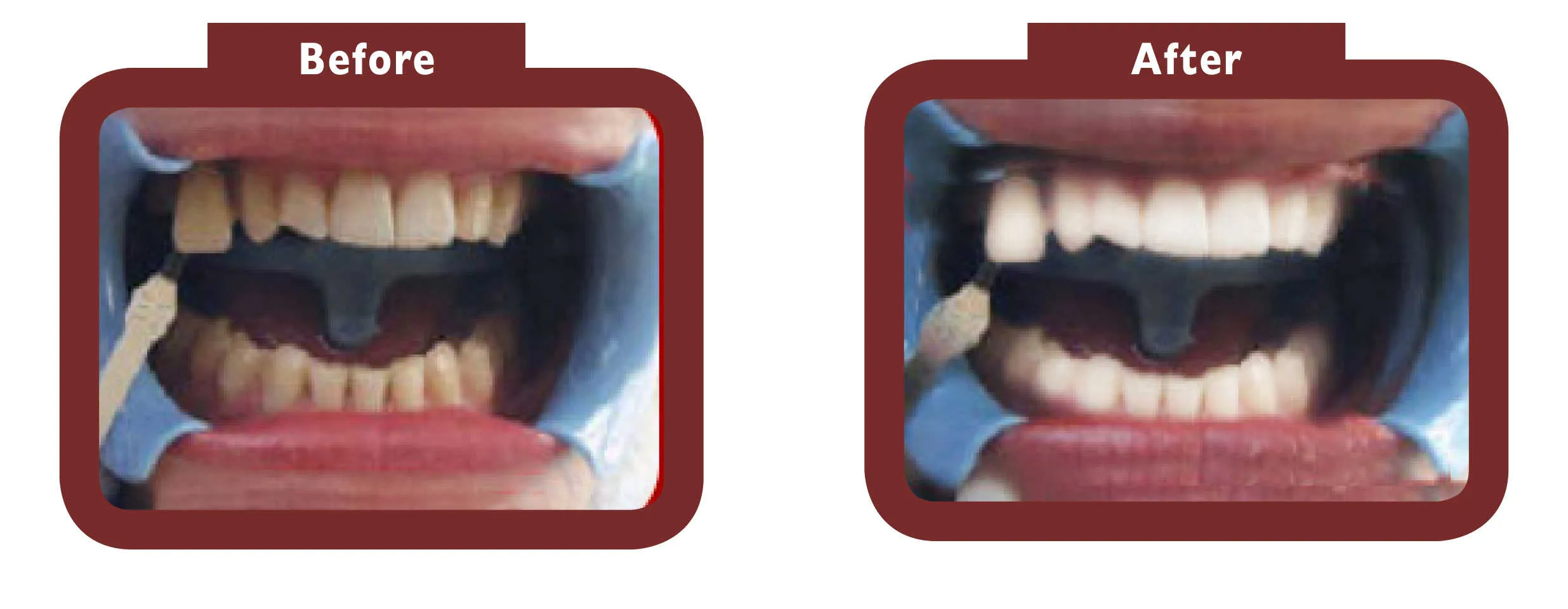 31994 teeth whitening consultation