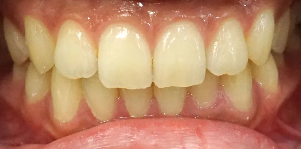 31994 teeth whitening smile