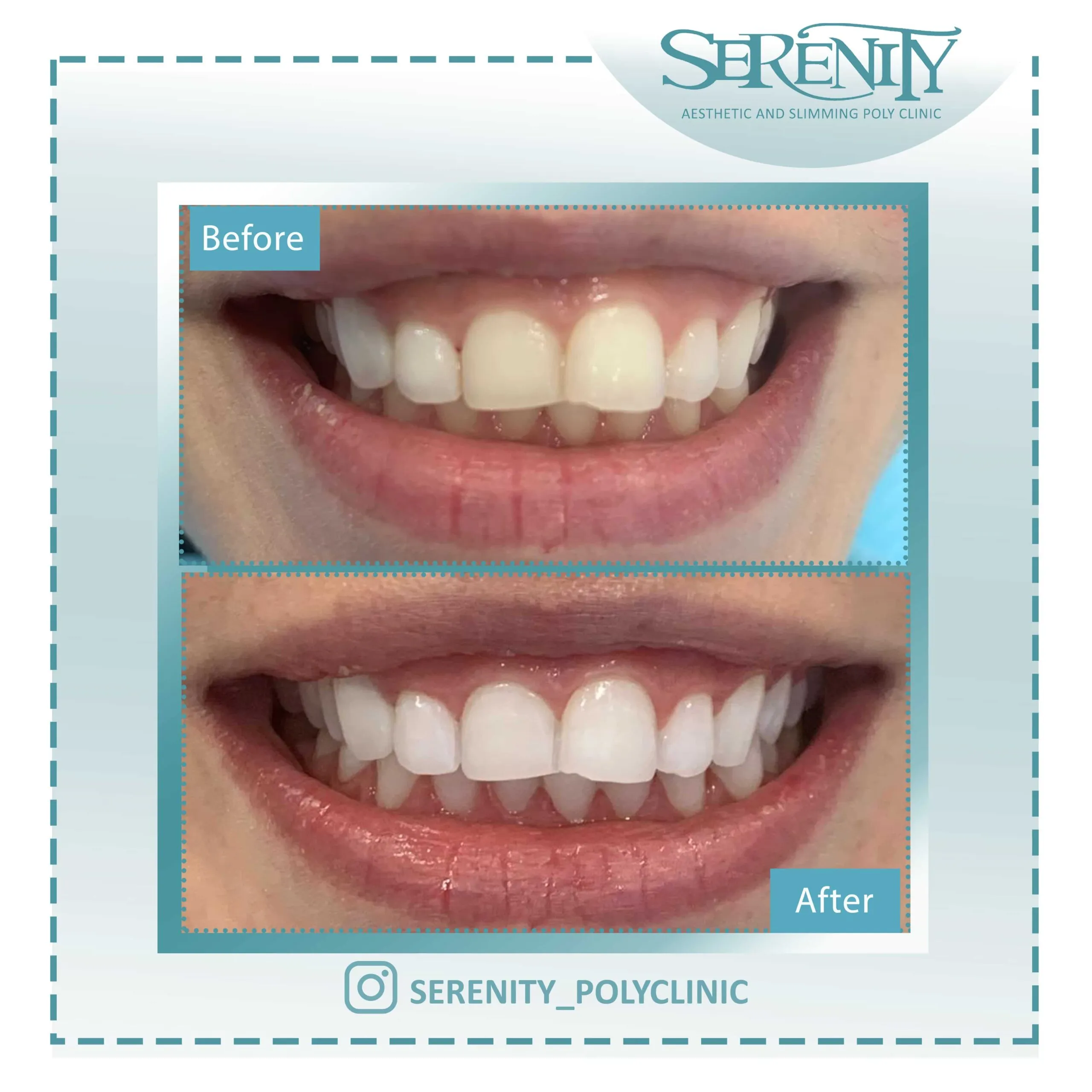 31995 teeth whitening dubai dentist