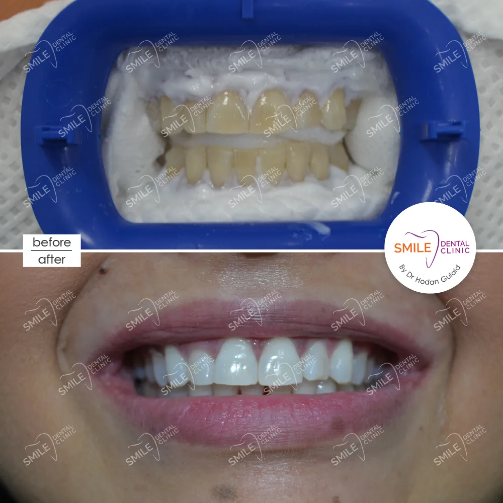 31995 teeth whitening dubai oral hygiene