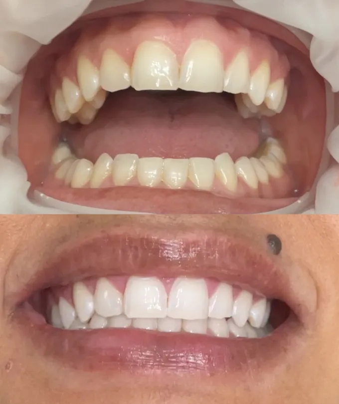 32003 in office whitening