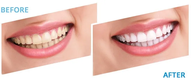 32004 teeth whitening at home kit