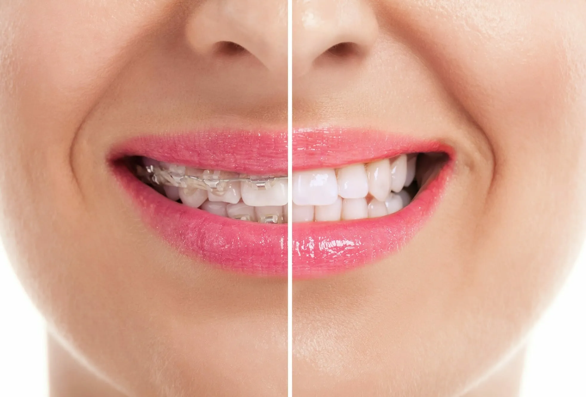 32010 professional whitening image3