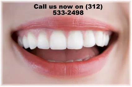 32011 over the counter whitening