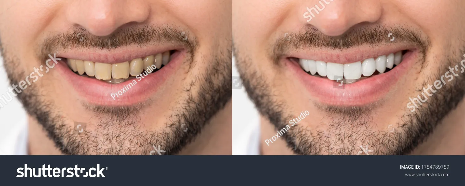 32013 natural teeth whitening