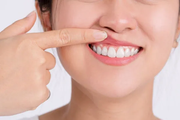 32015 teeth whitening maintenance