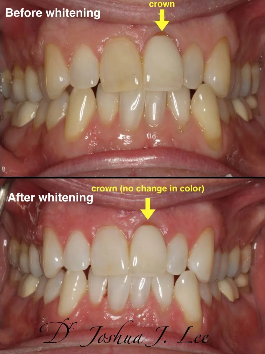 32016 zoom whitening factors