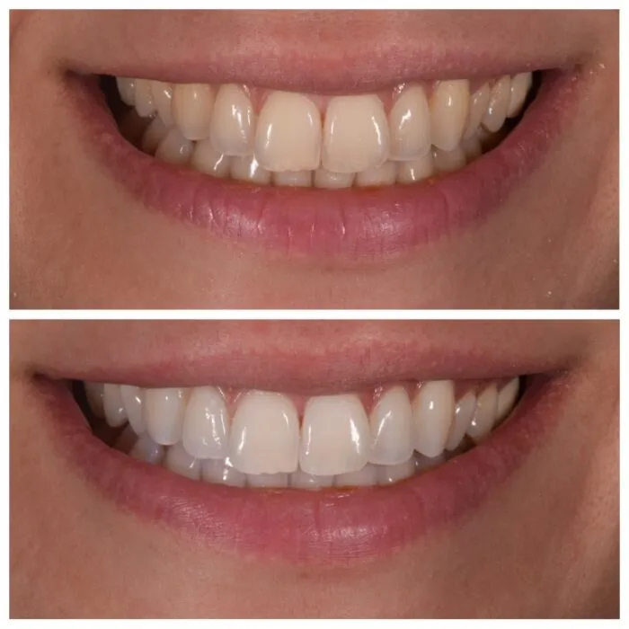 32016 zoom whitening tips
