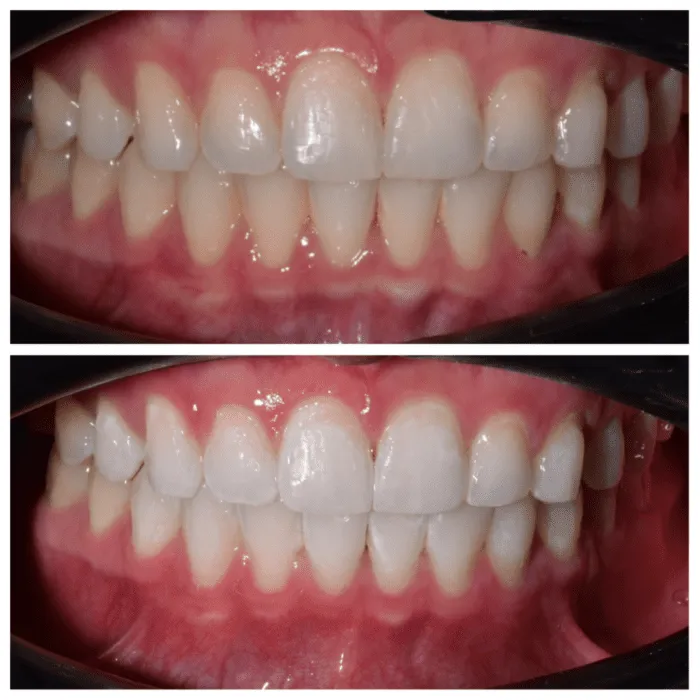 32016 zoom whitening vs other
