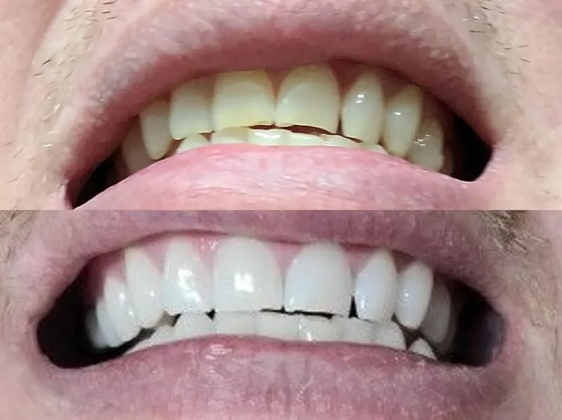 32017 sensitive teeth