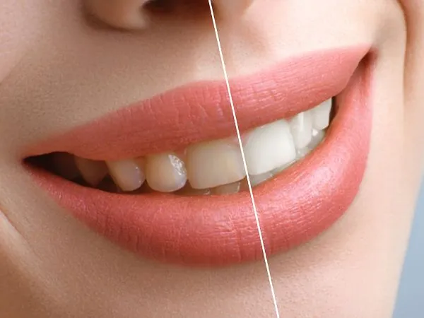 /img/32024-natural-teeth-whitening.webp