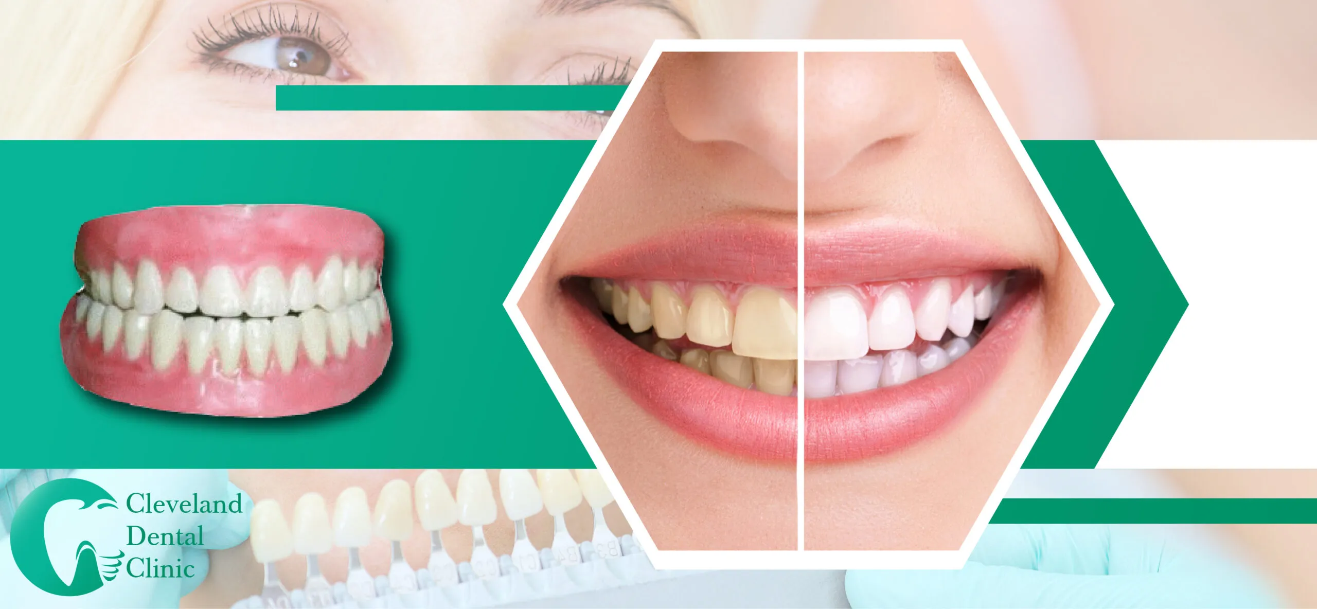 32024 professional teeth whitening