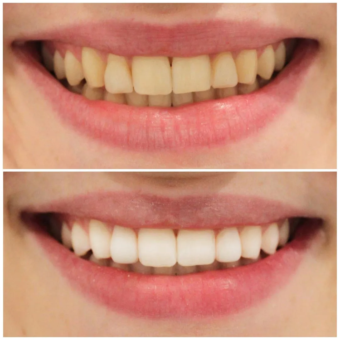 32025 teeth whitening diet