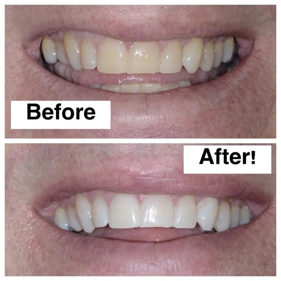 32025 teeth whitening smile