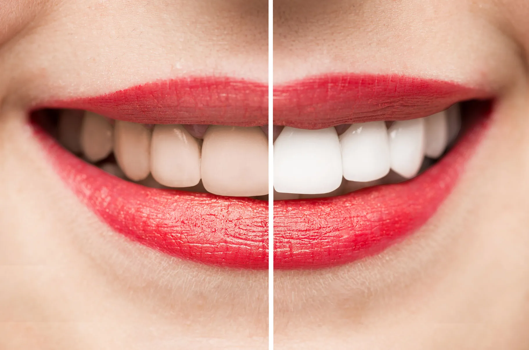 32025 teeth whitening treatment